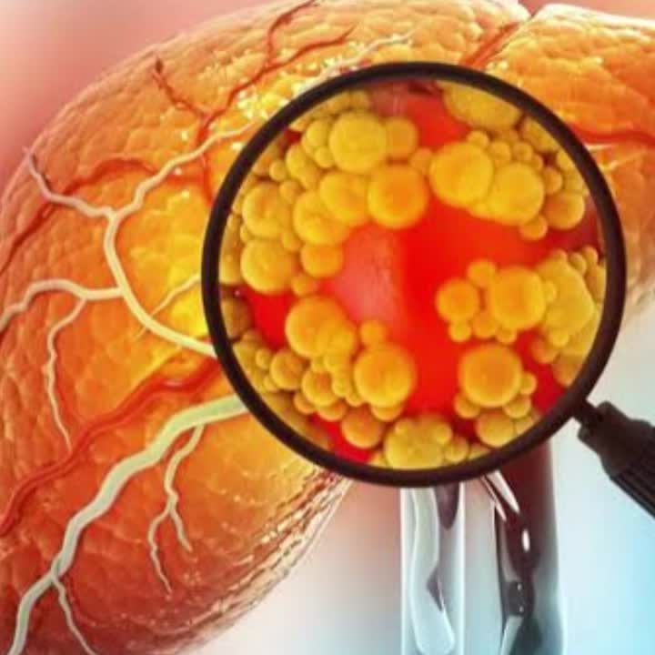 Magnified view of liver tissue showing yellow fat deposits